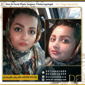 تصویر ارسالی عمل بینی زنانه