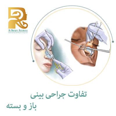 تفاوت جراحی بینی باز و بسته 
