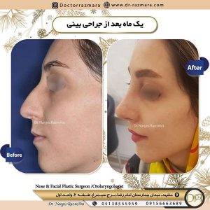 جراحی بینی استخوانی زنانه