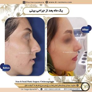 جراحی بینی استخوانی