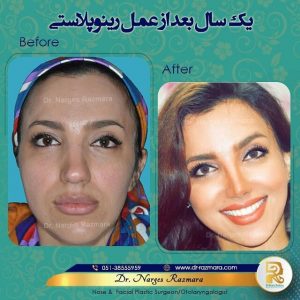 بعد یه سال از عمل بینی