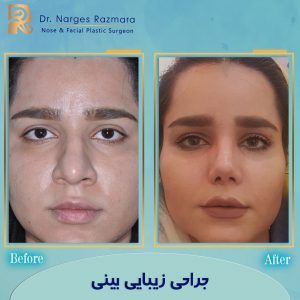 جراحی زیبایی بینی