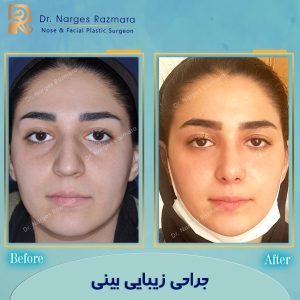 جراحی زیبایی بینی