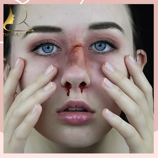 جراحی بینی شکسته در مشهد - دکتر رزم آرا