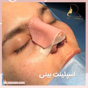 اسپلینت بینی + دکتر نرگس رزم آرا