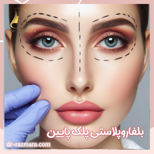 بلفاروپلاستی پلک پایین در مشهد - دکتر نرگس رزم آرا