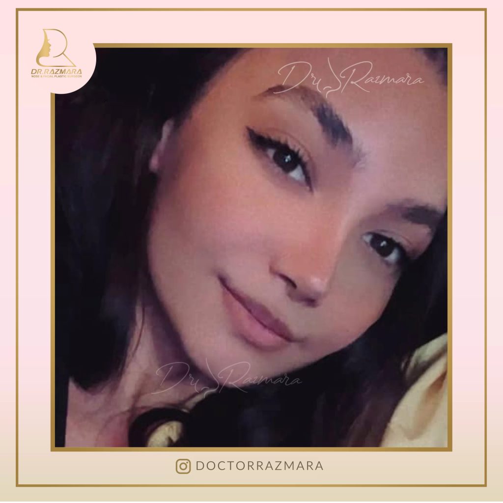 جراحی بینی در مشهد - دکتر رزم آرا