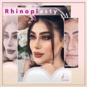 جراحی بینی نیمه فانتزی در مشهد - دکتر رزم آرا