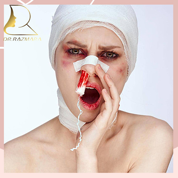 تامپون بینی - دکتر رزم آرا