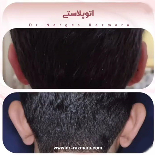 جراحی زیبایی گوش در مشهد + دکتر نرگس رزم آرا