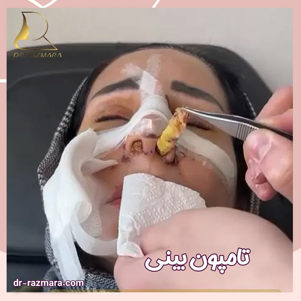 تامپون بینی + دکتر نرگس رزم ارا
