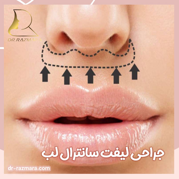 جراحی لیفت سانترال لب در مشهد + دکتر رزم آرا