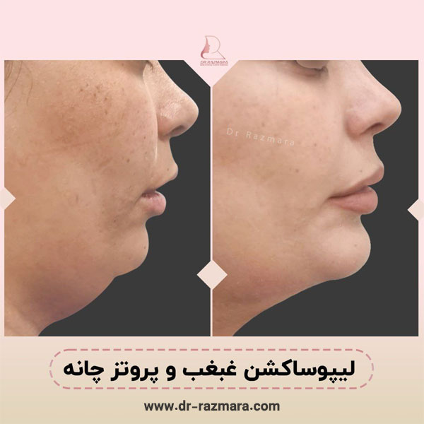 جراحی پروتز چانه در مشهد با دکتر نرگس رزم