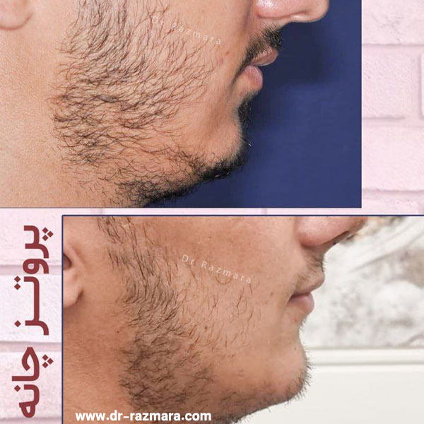 جراحی پروتز چانه در مشهد با دکتر نرگس رزم