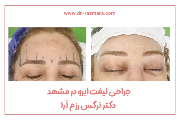 جراحی لیفت ابرو در مشهد + دکتر نرگس رزم آرا