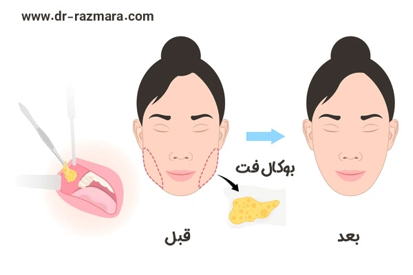 بوکال فت در مشهد + دکتر نرگس رزم آرا