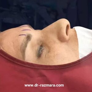 لیفت گونه در مشهد + دکتر نرگس رزم آرا 