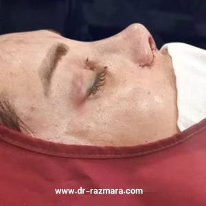 لیفت گونه در مشهد + دکتر نرگس رزم آرا 