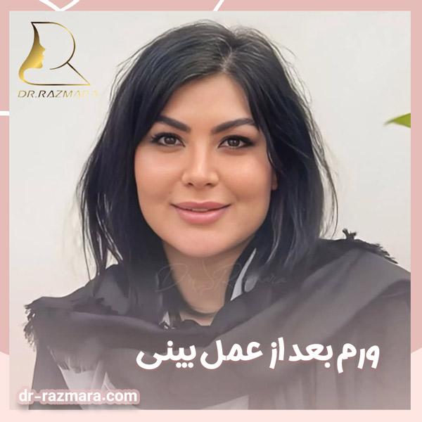 ورم بعد از عمل بینی + دکتر نرگس رزم آرا