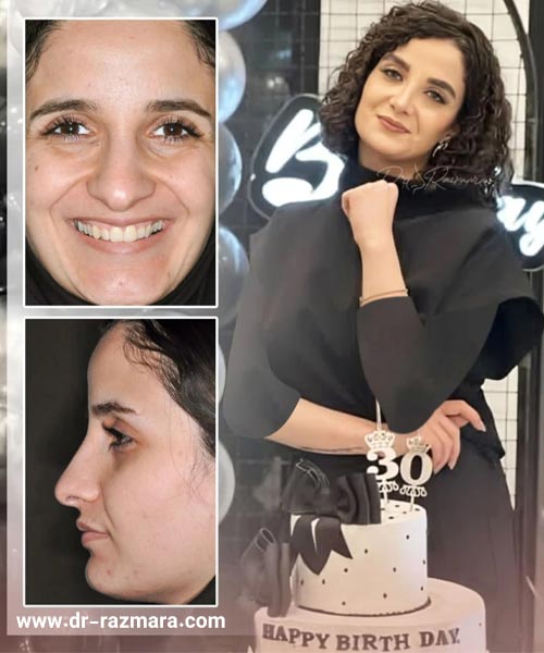 جراحی بینی نیمه فانتزی + دکتر نرگس رزم آرا