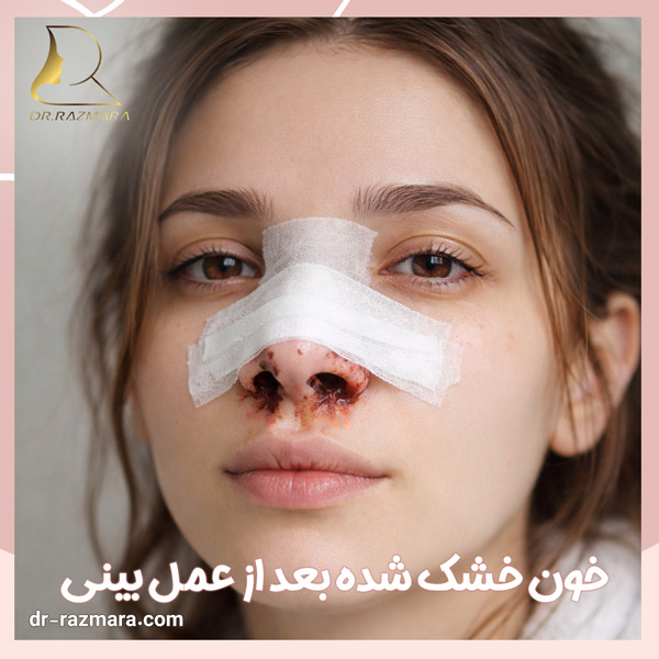 خون خشک شده بعد از عمل بینی + دکتر نرگس رزم آرا