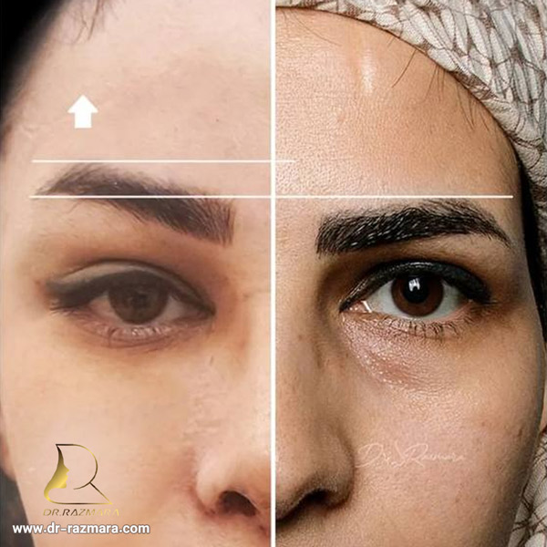 نمونه کارهای بهترین جراح لیفت ابرو در مشهد + دکتر نرگس رزم آرا