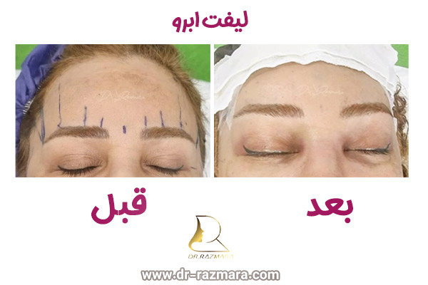 نمونه کارهای بهترین جراح لیفت ابرو در مشهد + دکتر نرگس رزم آرا