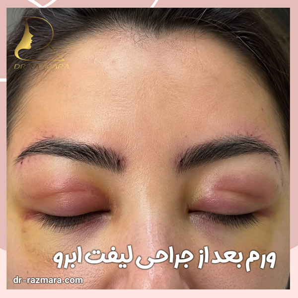 ورم بعد از جراحی لیفت ابرو + دکتر نرگس رزم آرا